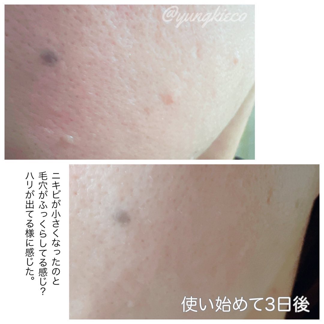 リードルショット300/VT/美容液を使ったクチコミ（3枚目）