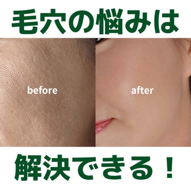 美肌カウンセラー💆綺麗のお助け相談所 on LIPS 「肌を綺麗にする専門家💆美肌カウンセラーおすすめ＼毛穴の悩みは改..」（1枚目）