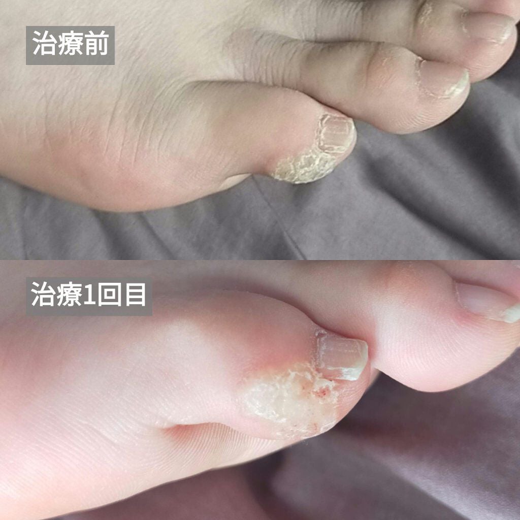 敏感肌な研究者💊あすか💊 on LIPS 「⚠️グロ注意⚠️ #イボ取り日記いやーしんどいです😱なかなか終..」(4枚目)