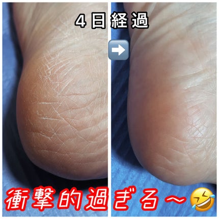 尿素10%クリーム/ハンド・尿素シリーズ/ハンドクリームを使ったクチコミ(2枚目)