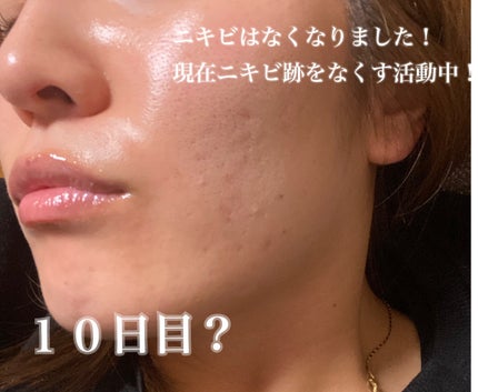 ペアアクネクリームW(医薬品)/ペア/その他を使ったクチコミ(8枚目)