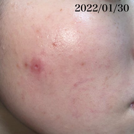 薬用しみ集中対策 プレミアム美容液/メラノCC/美容液を使ったクチコミ(4枚目)