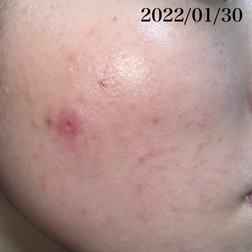 薬用しみ集中対策 プレミアム美容液/メラノCC/美容液を使ったクチコミ(4枚目)