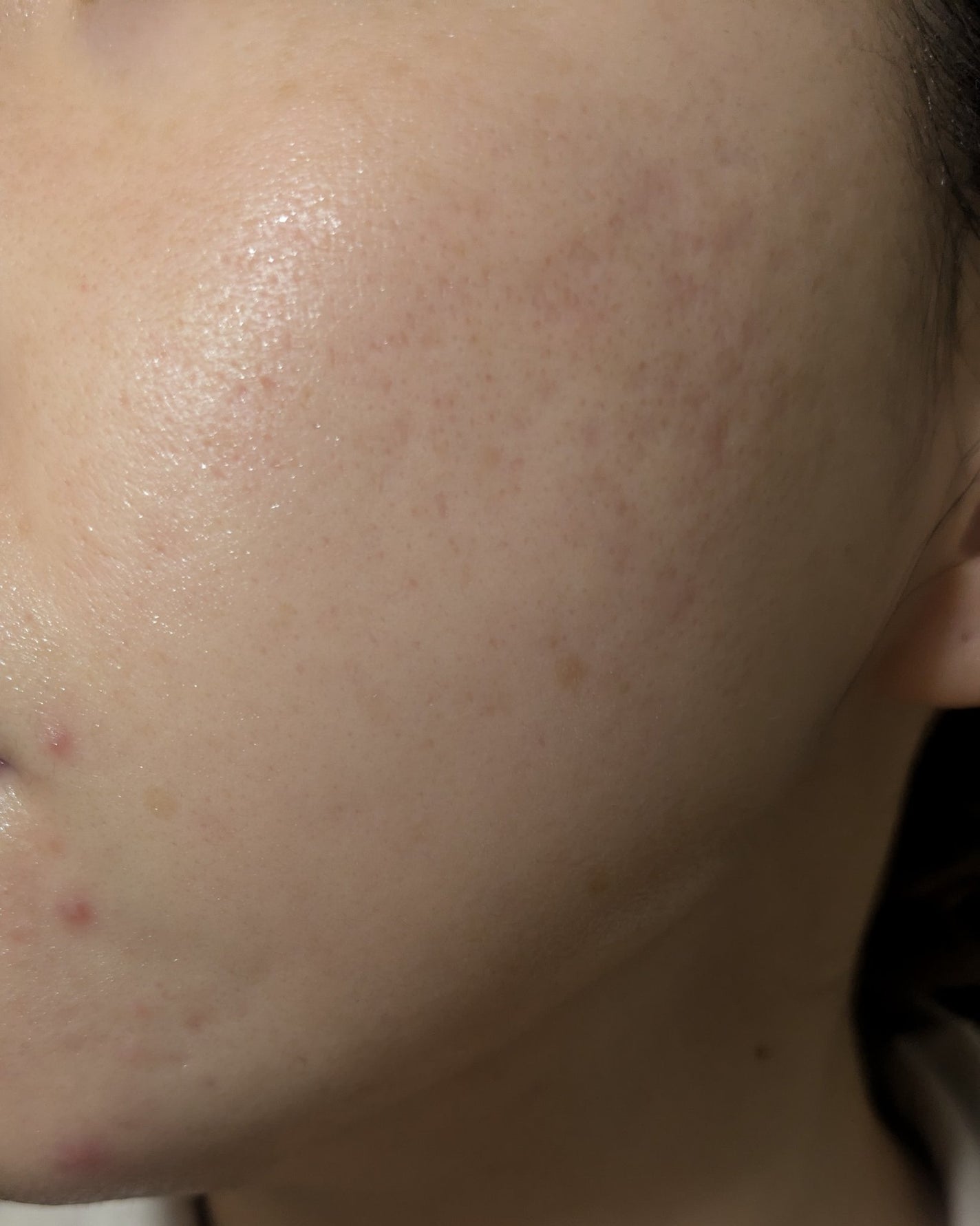 miina@汚肌工事録⚠️ on LIPS 「11/8の#汚肌工事録この頃、これでもまだ荒れ始めです😂..」(2枚目)