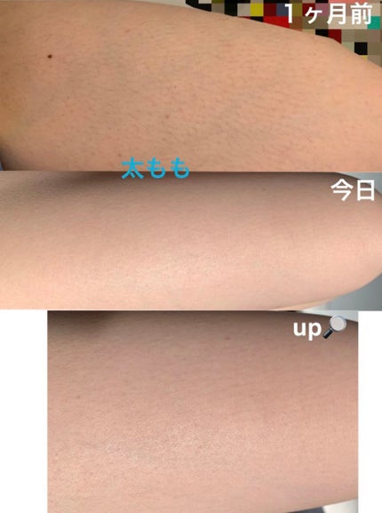 光脱毛器 VIO/Sarlisi/家庭用脱毛器を使ったクチコミ(5枚目)