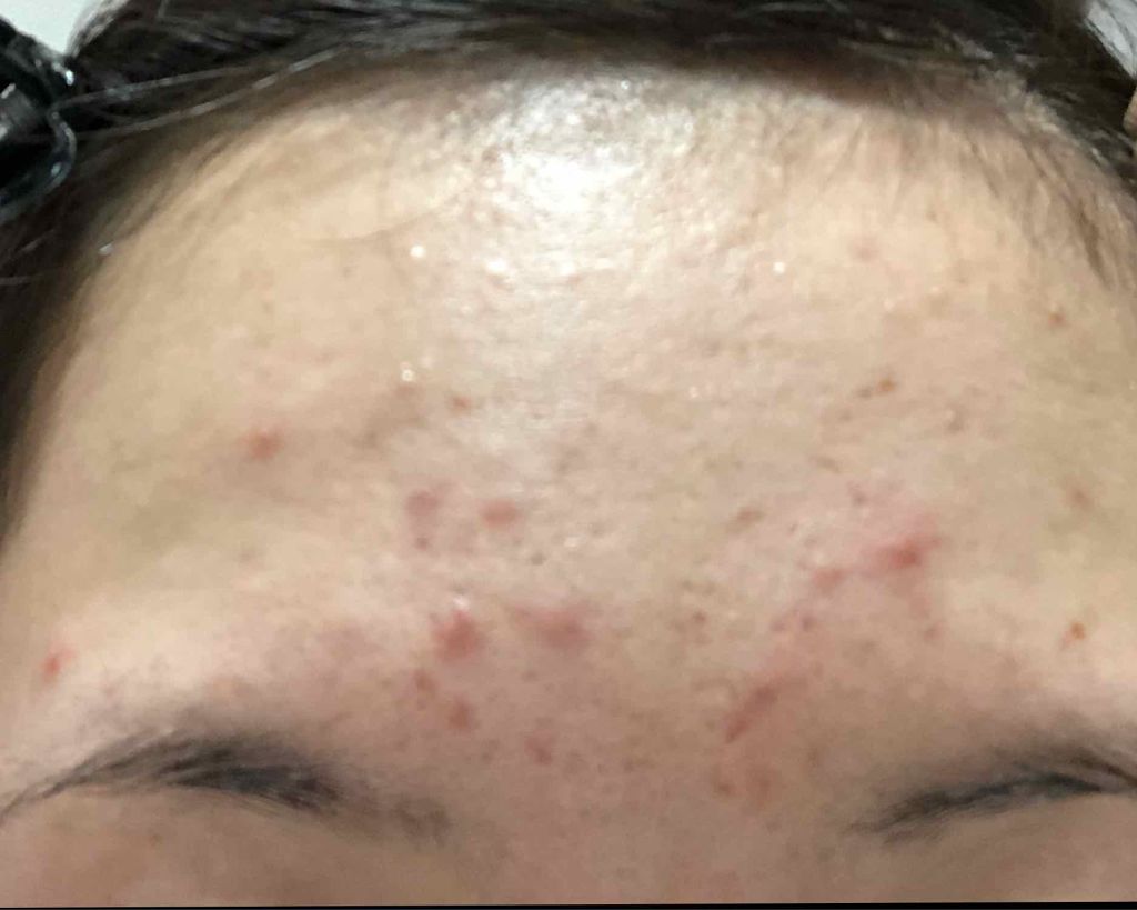 ACC パッチ/ETUDE/シートマスク・パックを使ったクチコミ(2枚目)