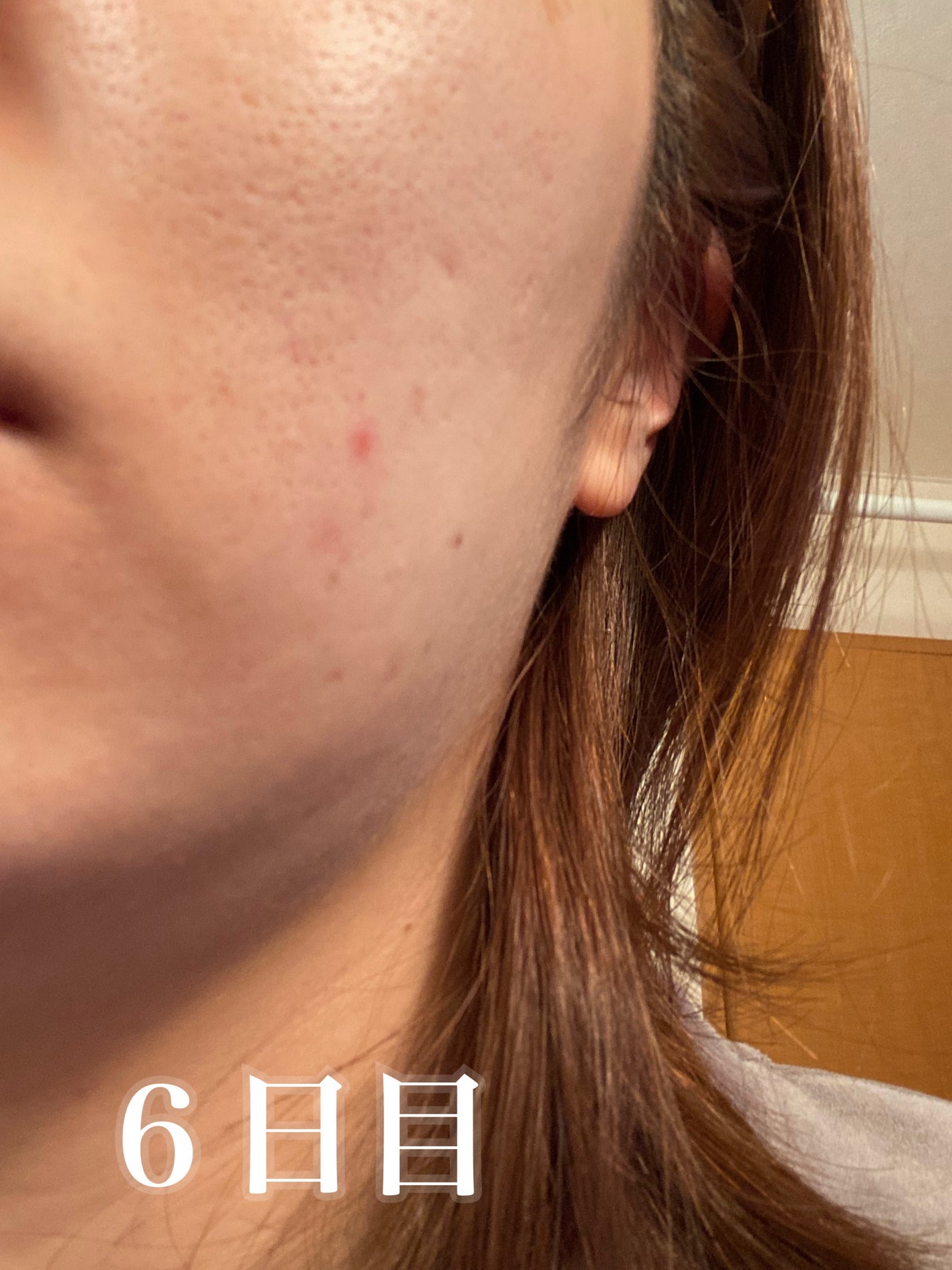 ペアアクネクリームW(医薬品)/ペア/その他を使ったクチコミ(6枚目)