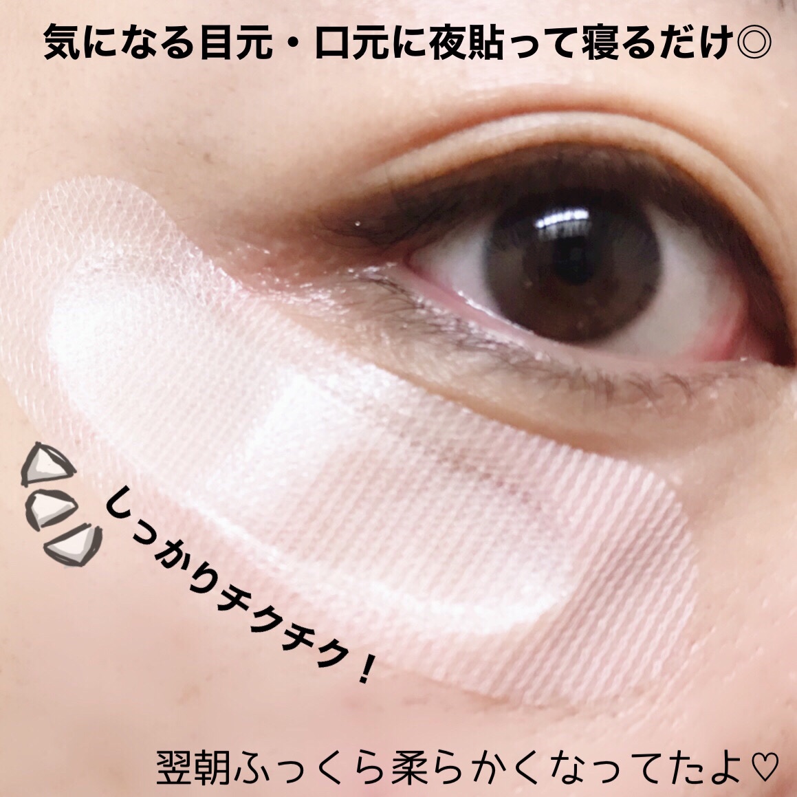 フイルナチュラント IC．U HA マイクロパッチのクチコミ「気になる所には直接刺す！！！しっかりチクチク感あり🪡
--------------------.....」（3枚目）