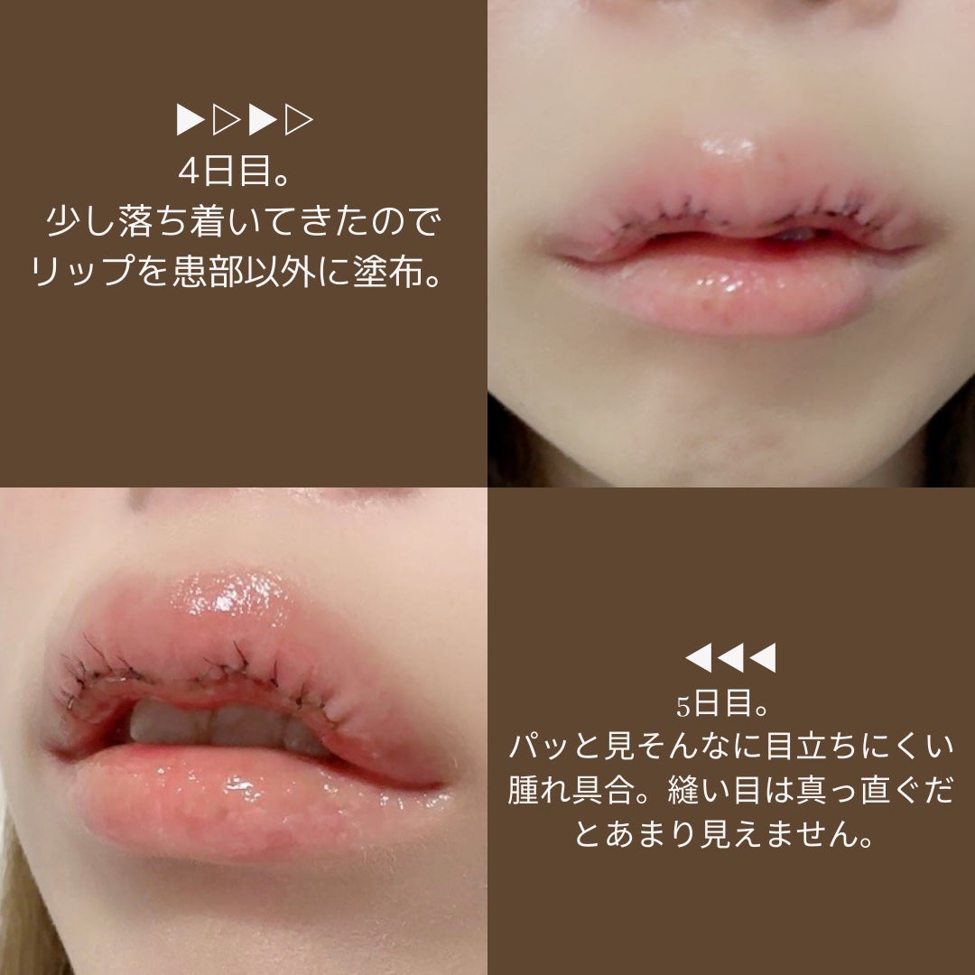 春風ゆうか🧸フォロバ100 on LIPS 「M字リップ形成!ダウンタイムも公開!💋。*⑅୨୧┈┈┈┈┈┈┈..」(3枚目)
