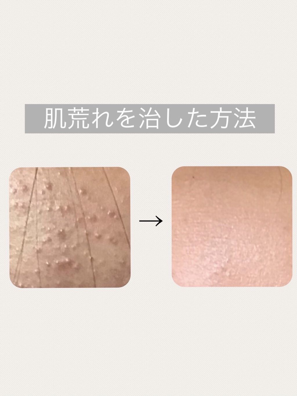 A アクネフォーム/NOV/洗顔フォームを使ったクチコミ（1枚目）