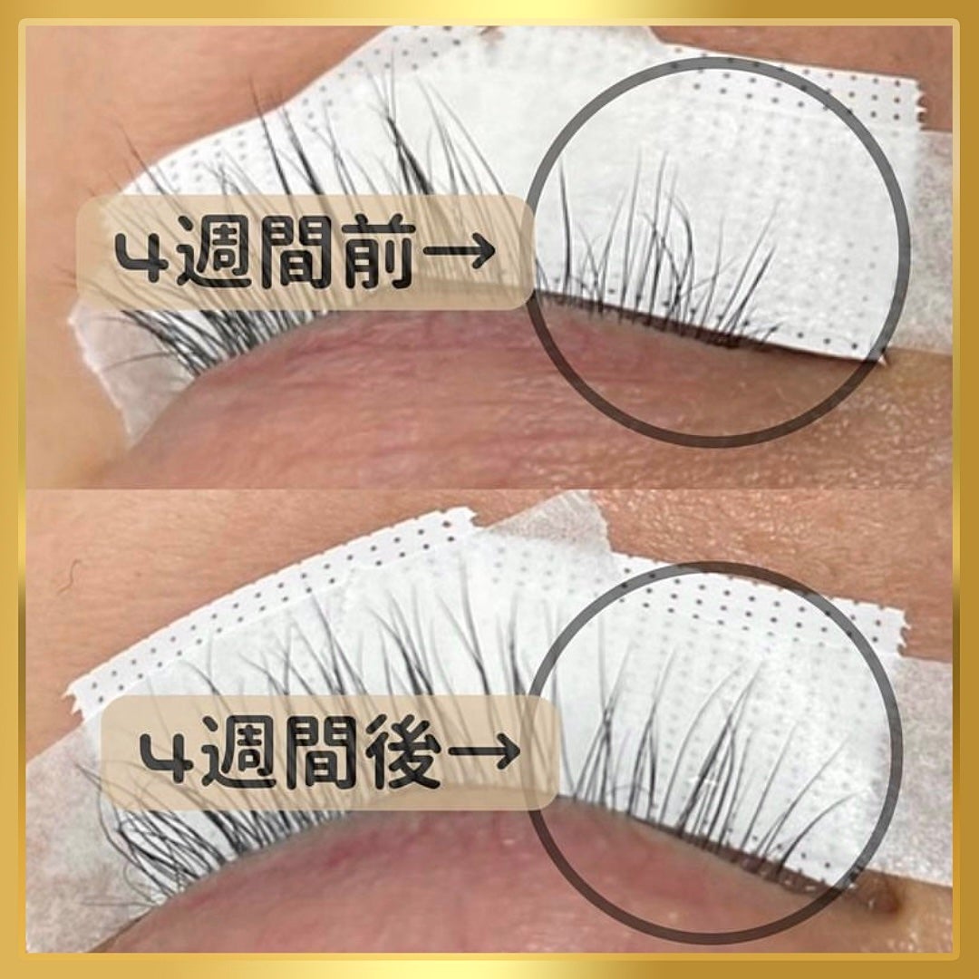 ããðãŸã€ãã±ã¢åœ on LIPS ãããŸã€æ¯çŸå®¹æ¶²ãã䜿ãå§ããŠ4é±éçµéããæã®ãŸã€æ¯ã®ç¶æ
ã§ã..ãïŒ1æç®ïŒ