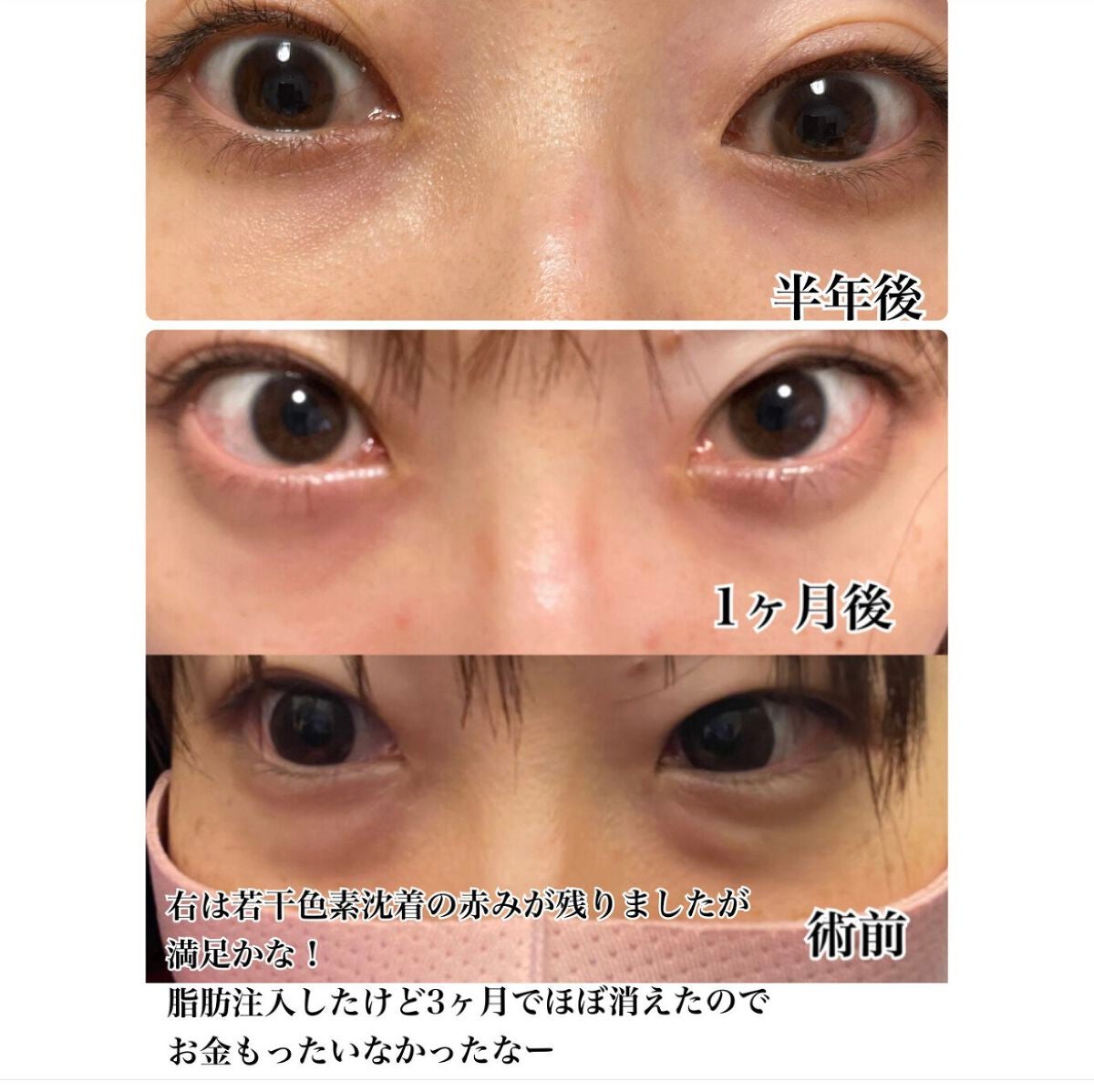 【旧】ディオールスキン フォーエヴァー スキン コレクト コンシーラー/Dior/リキッドコンシーラーを使ったクチコミ(7枚目)