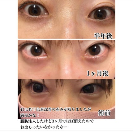 【旧】ディオールスキン フォーエヴァー スキン コレクト コンシーラー/Dior/リキッドコンシーラーを使ったクチコミ(7枚目)