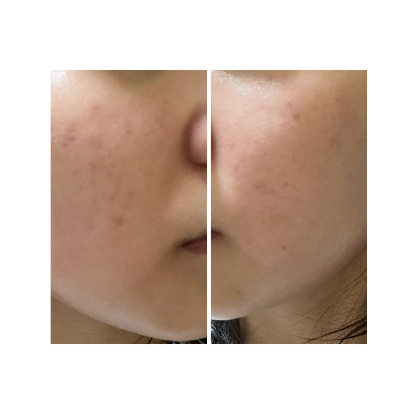 ぽむ on LIPS 「2023.9.13皮膚科に受診 エピデュオとヘパリン処方1枚目..」(5枚目)