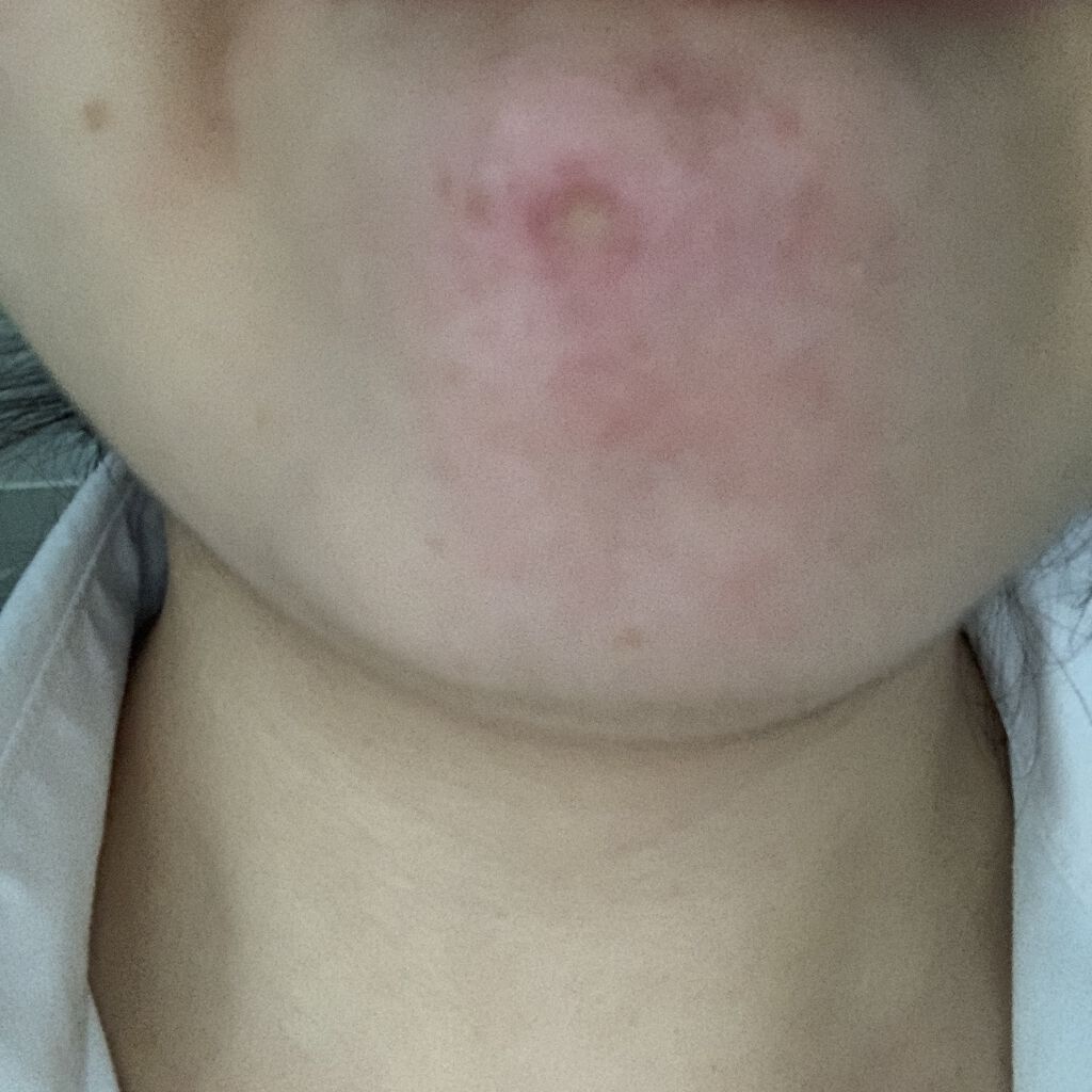 ノブ Ａ アクネソープ/NOV/洗顔石鹸を使ったクチコミ（3枚目）