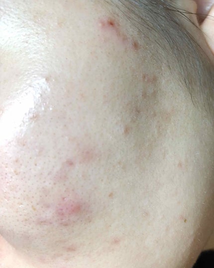 しろさい on LIPS 「初投稿です。今まで様々なものを使ってきましたが、なかなか治りま..」(3枚目)