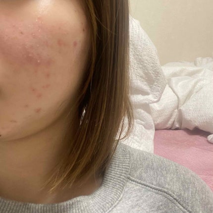 クリンダマイシンゲル(医薬品)/クラシエ薬品/その他を使ったクチコミ(2枚目)