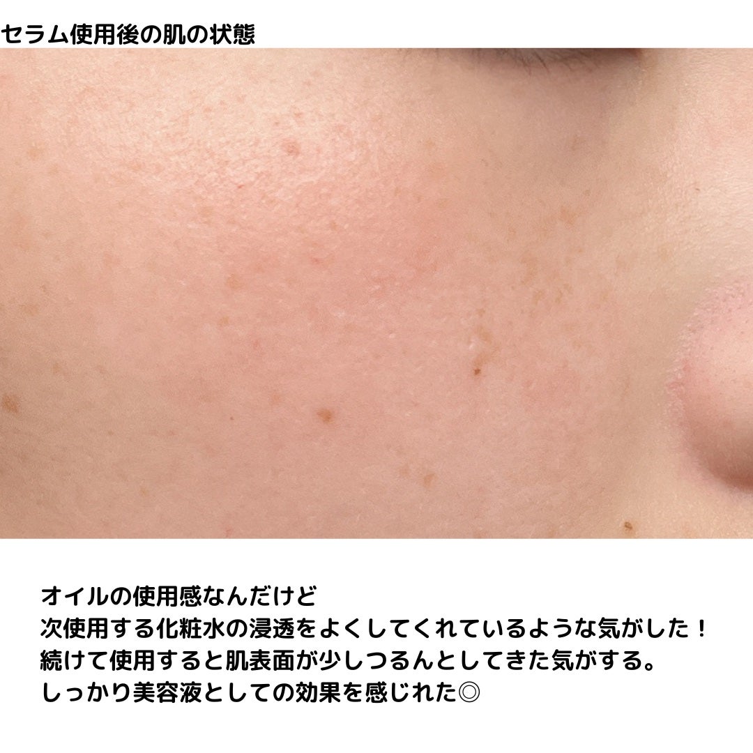 VC ホワイトピールセラム/SKIO/ブースター・導入液を使ったクチコミ(6枚目)