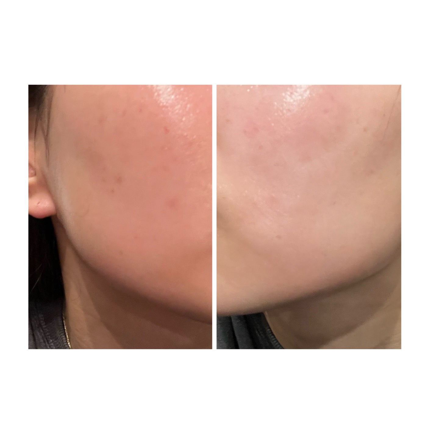 ぽむ on LIPS 「2023.9.13皮膚科に受診 エピデュオとヘパリン処方1枚目..」(3枚目)