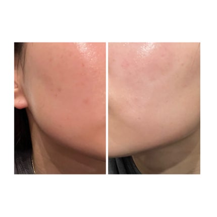 ぽむ on LIPS 「2023.9.13皮膚科に受診 エピデュオとヘパリン処方1枚目..」(3枚目)