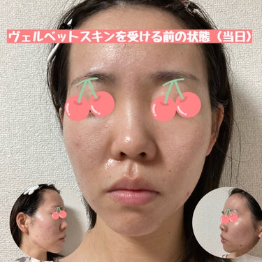 すみれ"25歳美容部員" on LIPS 「今日はダーマペンとオプションのヴェルベットスキンを受けてきまし..」（2枚目）