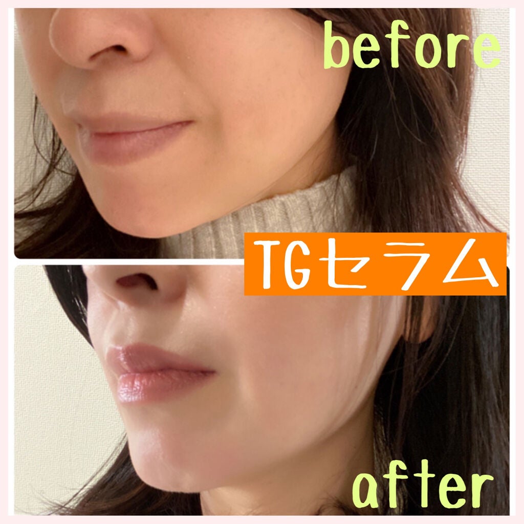 fuka712 on LIPS 「マイクロニードルは注目していて、口元・目元の貼るマイクロニード..」(4枚目)