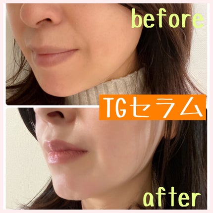 fuka712 on LIPS 「マイクロニードルは注目していて、口元・目元の貼るマイクロニード..」(4枚目)