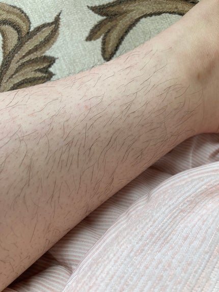 光美容器KE-NON(ケノン)/エムテック/家庭用脱毛器を使ったクチコミ(6枚目)