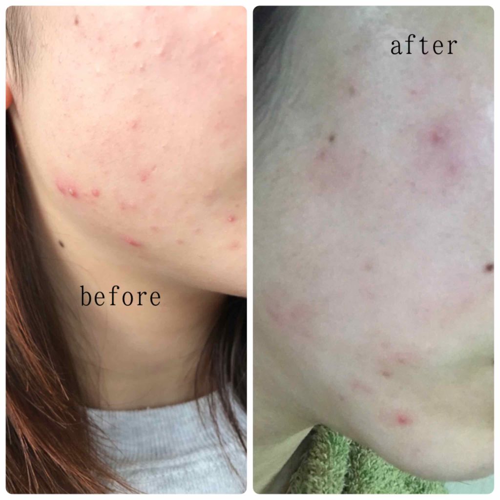 薬用 雪肌精/雪肌精/化粧水を使ったクチコミ（2枚目）