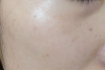 CHA on LIPS 「シミ取りレーザー8日目。右頬にあったおっきなシミがポロって取れ..」(4枚目)