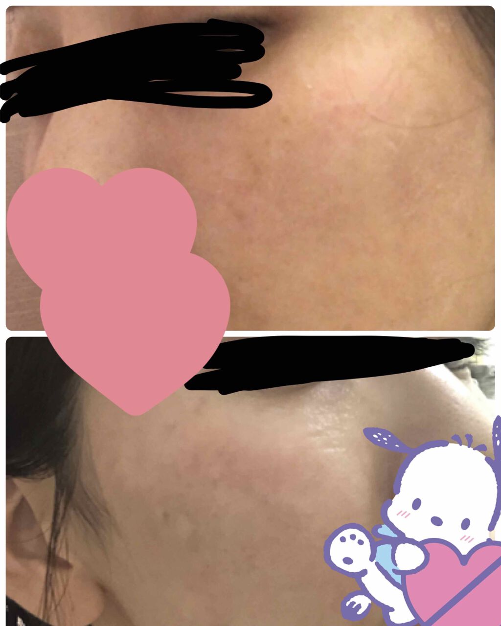 ねこ村 on LIPS 「また間が空きましたが、シミ取りレーザーの経過残ったシミがすこし..」(2枚目)