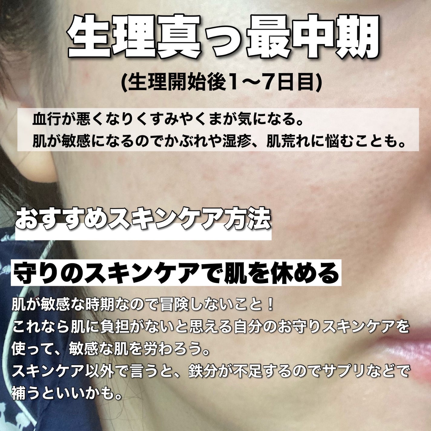 A アクネフォーム/NOV/洗顔フォームを使ったクチコミ(5枚目)