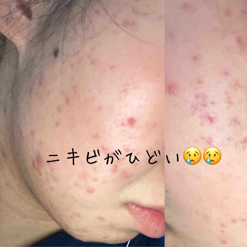あーーめん on LIPS 「何年もニキビに悩んでいます。ニキビがひどく、周りの目ばかり気に..」(1枚目)