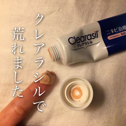 ニキビ治療薬クリーム (医薬品)/クレアラシル/その他を使ったクチコミ(1枚目)