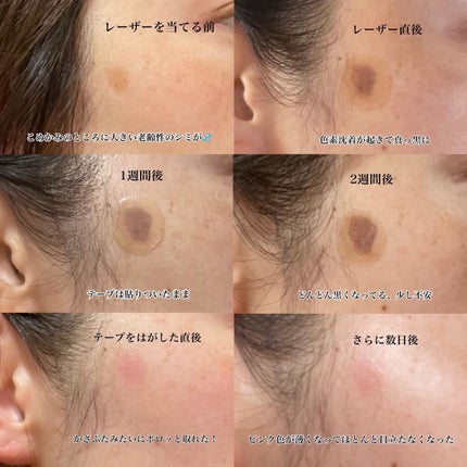 こはる on LIPS 「シミ取り行ってきました今月のシミ取りは肝斑治療ではなく頬の部分..」(3枚目)