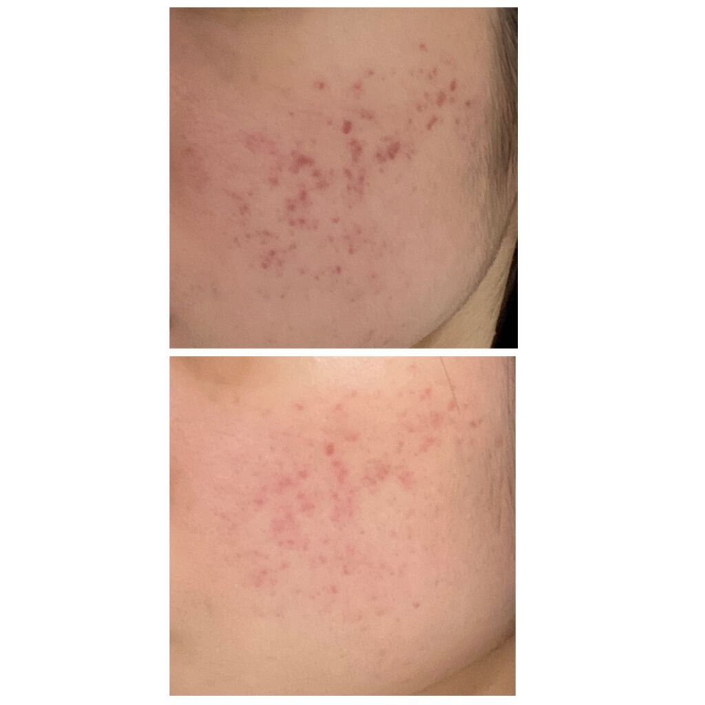 01_ringo_01 on LIPS 「上の写真が1日目、下の写真が薬を塗り始めて82日目💊もう少しで..」(3枚目)