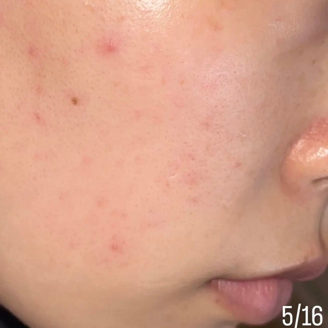 ペアアクネクリームW(医薬品)/ペア/その他を使ったクチコミ(4枚目)