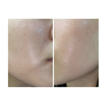 ぽむ on LIPS 「2023.9.13皮膚科に受診 エピデュオとヘパリン処方1枚目..」(1枚目)