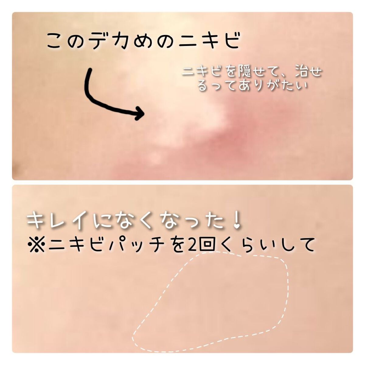 プロCICA クリアスポットパッチ/VT/その他スキンケアを使ったクチコミ(3枚目)