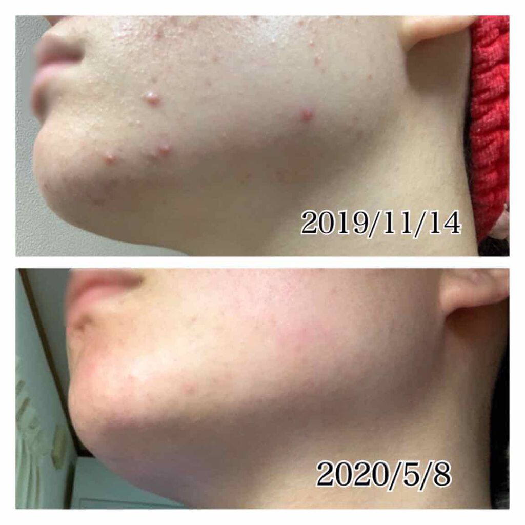 コールドクリーム/ウテナモイスチャー/クレンジングクリームを使ったクチコミ(3枚目)