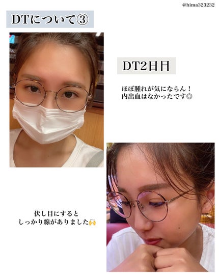 ひまちゃん /垢抜けの参考書 on LIPS 「【整形】〜私が施術した二重埋没について〜本日は!1年半くらい前..」(6枚目)