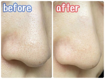 ノーモアブラックヘッド(ノーズピーリング)/One-day's you/スクラブ・ゴマージュを使ったクチコミ(3枚目)