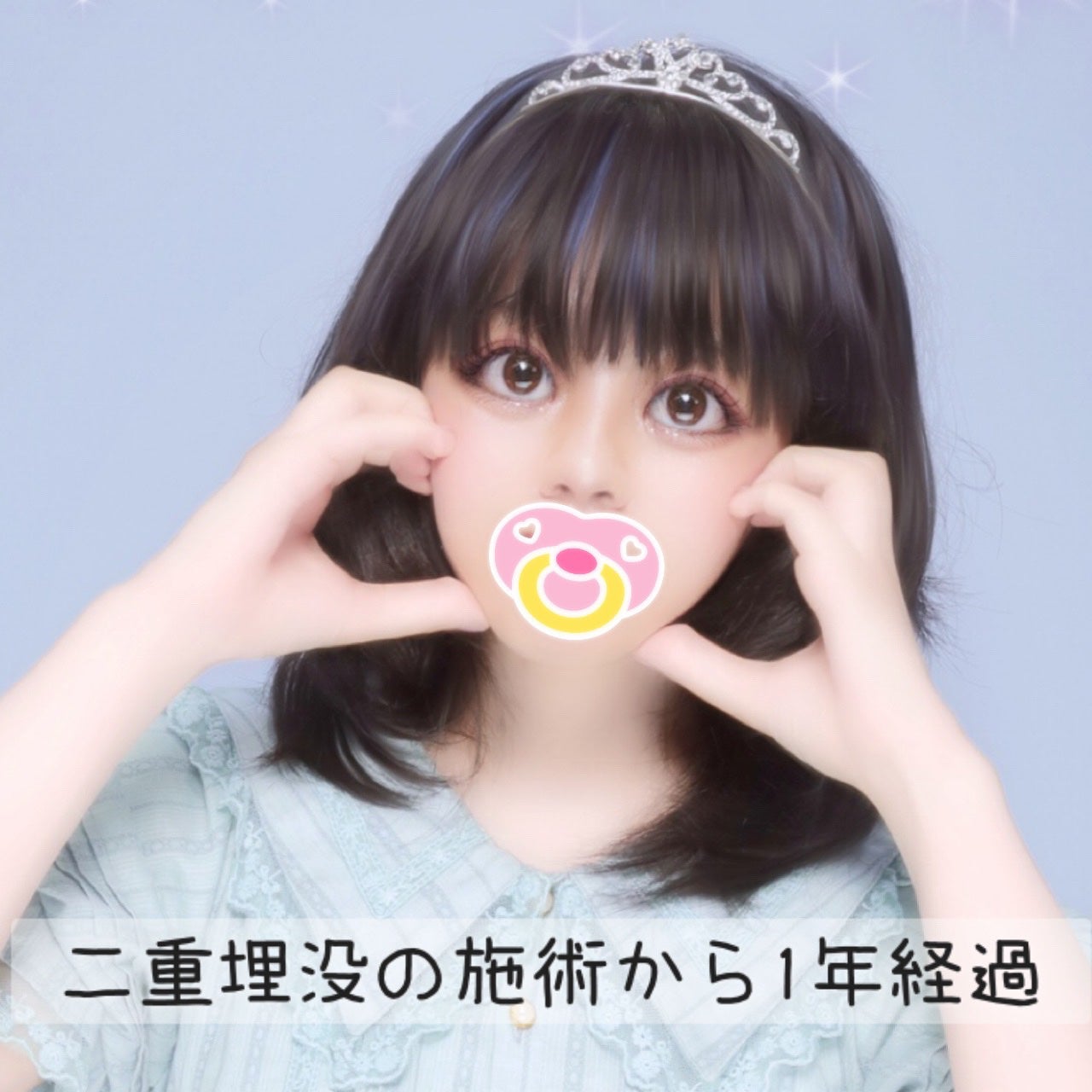 りんごあめ on LIPS 「先日、二重整形の埋没法の施術を受けてから1年が経過しました🙌✨..」(1枚目)