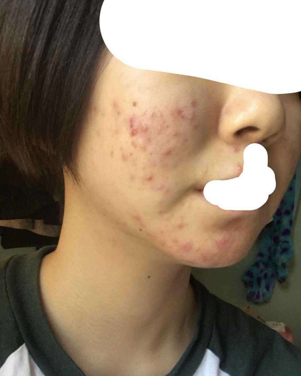 あした on LIPS 「6日目!良くなってきてはいるけどー、、大きな変化は感じられない..」(2枚目)