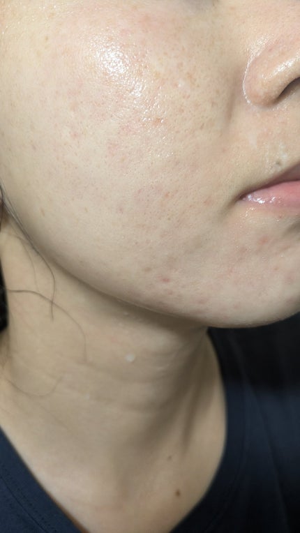 A2+NAG2ソリューション/The Ordinary/美容液を使ったクチコミ(1枚目)