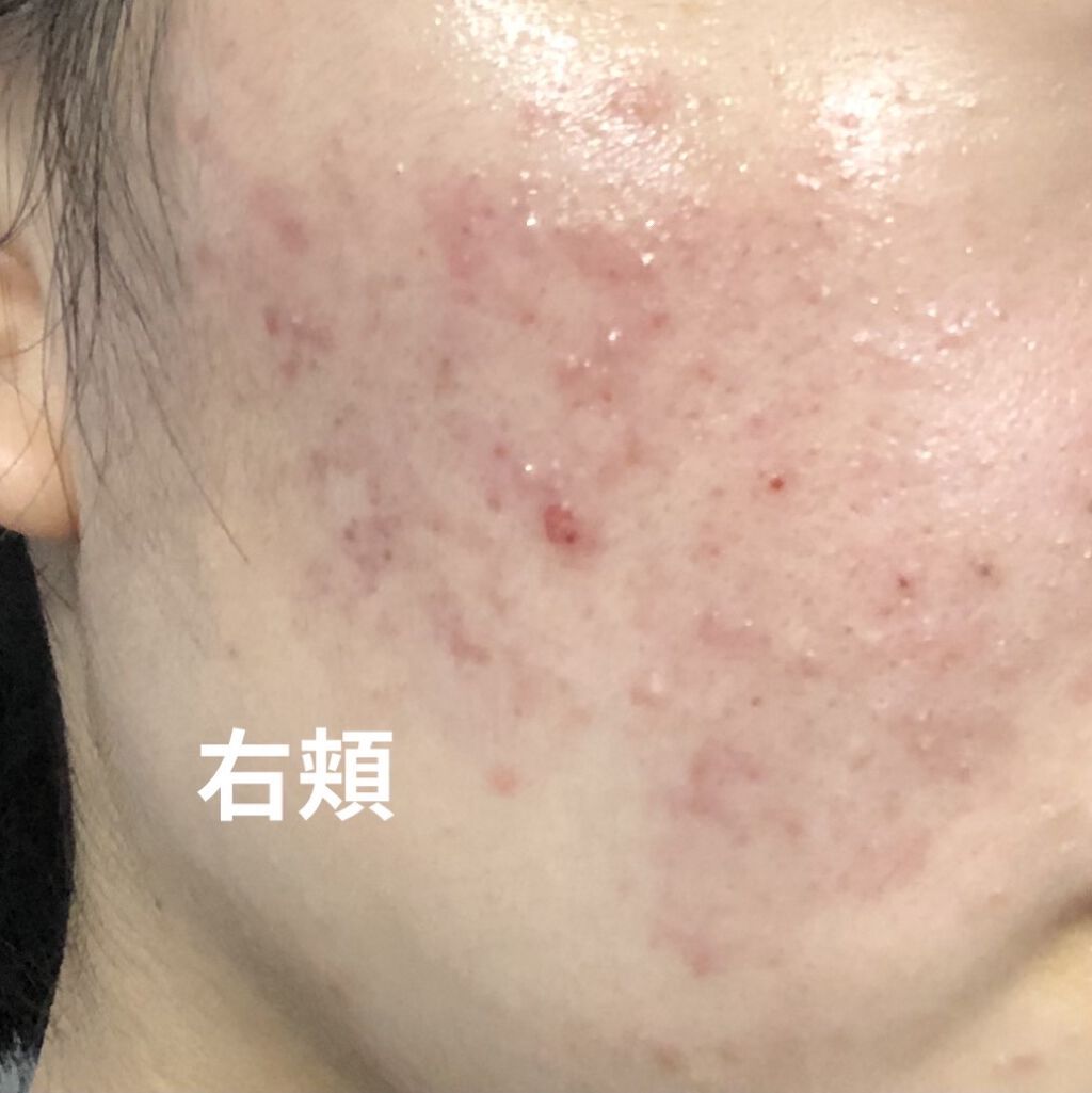 ペアアクネクリームW(医薬品)/ペア/その他を使ったクチコミ（2枚目）