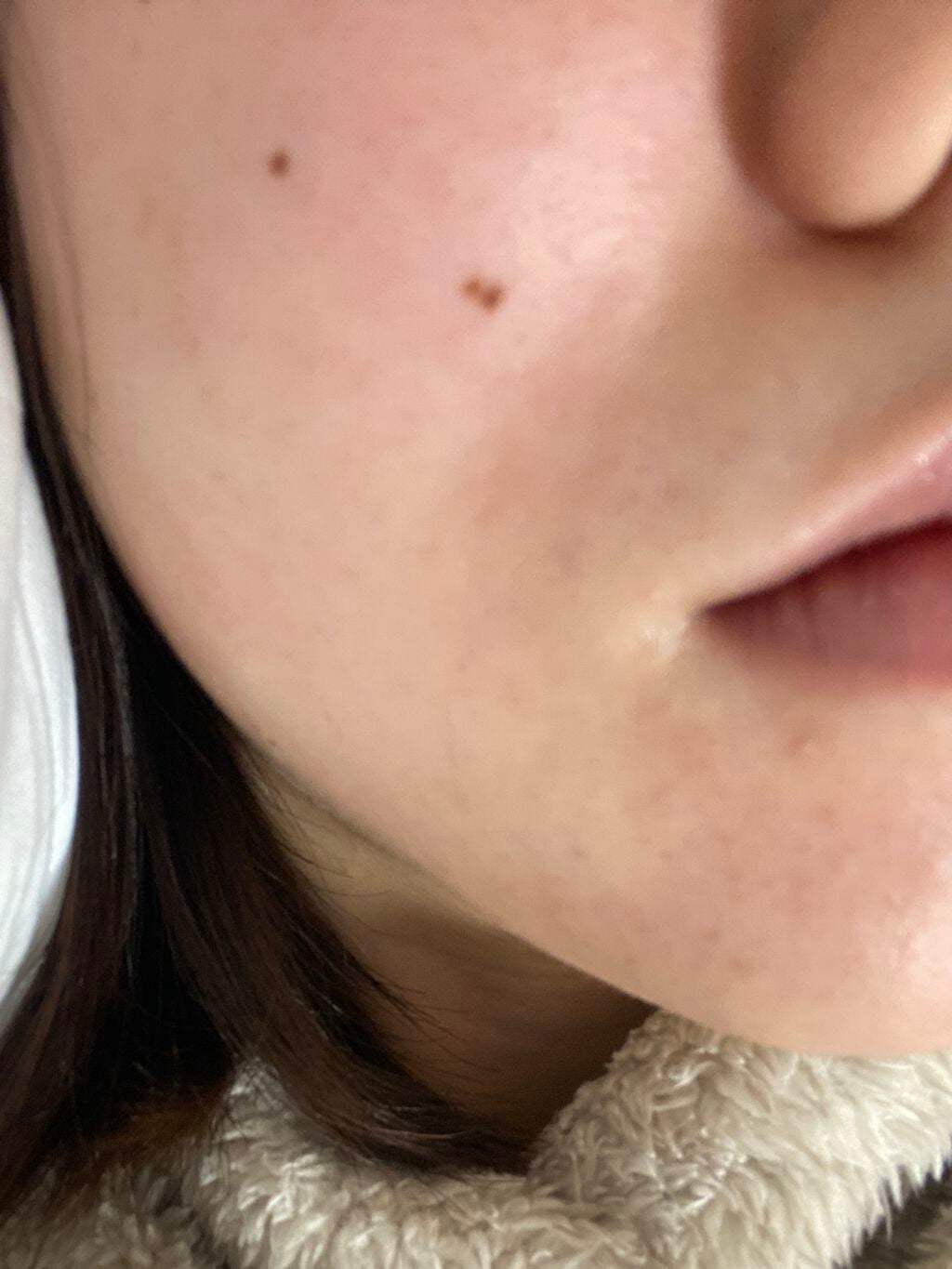 aya on LIPS 「【1ヶ月の成長】お久しぶりです❕❕❕肌荒れ日記約1ヶ月後の更新..」(5枚目)