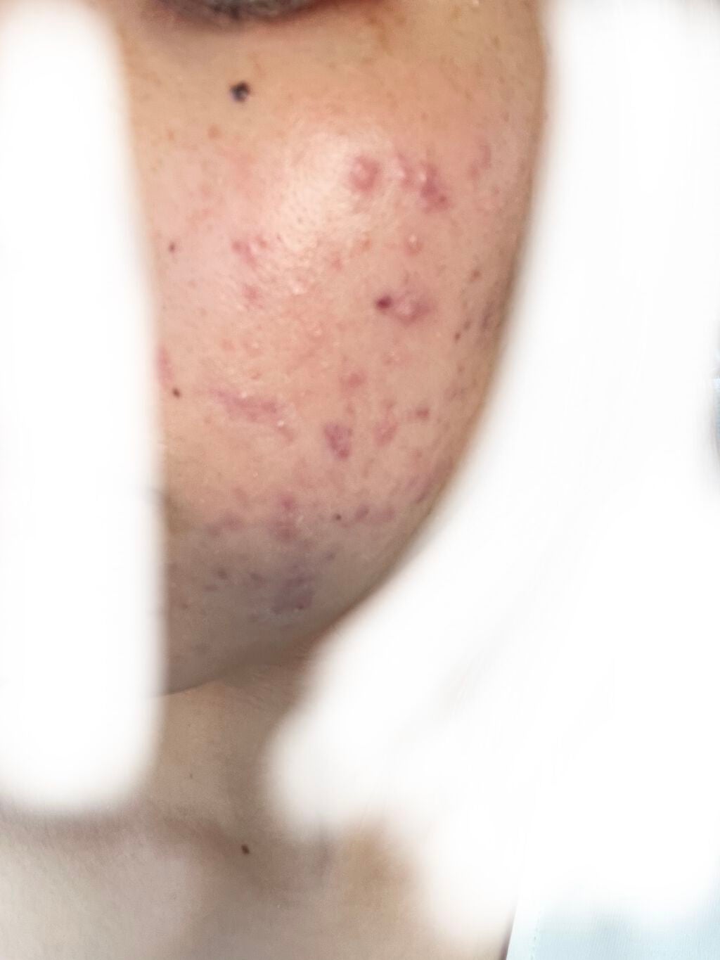 あめ on LIPS 「ゼビアックスの薬を塗ると皮?ポロポロむけてしまうんだけどこれは..」(2枚目)