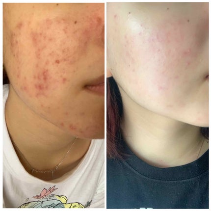 薬用しみ対策 美白化粧水/メラノCC/化粧水を使ったクチコミ(2枚目)