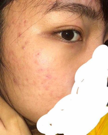 マスキング レイアリング アンプル エクセルトーニングショット/MEDIHEAL/美容液を使ったクチコミ(2枚目)